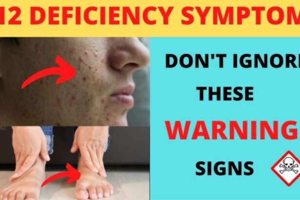 Vitamin B12 deficiency